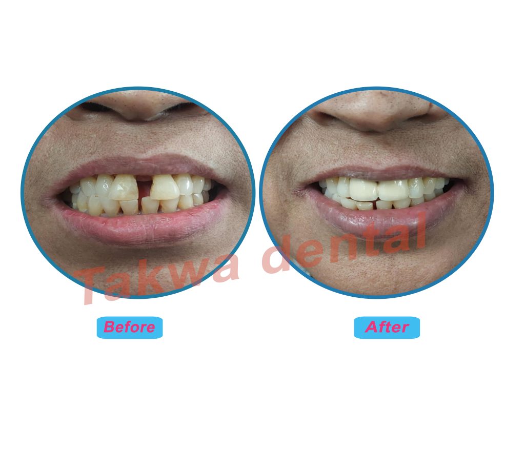 gap closed with zirconia caps, natural aligned smile