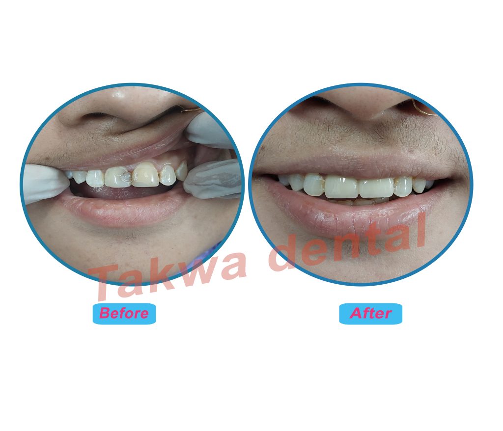 Before Zirconium Cap – Damaged or discolored tooth condition