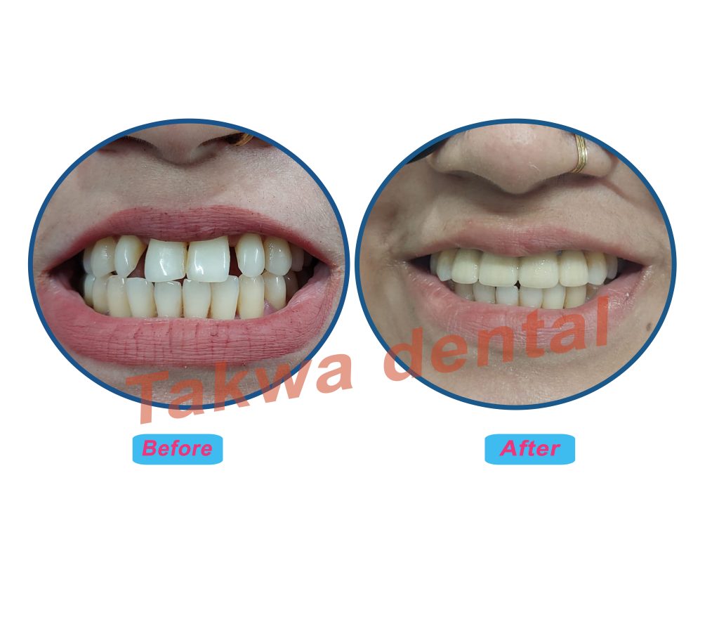 Patient smiling after dental bridge treatment at Takwa Dental